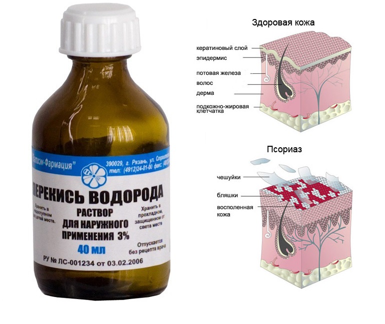 lechenie psoriaza perekisyu vodoroda