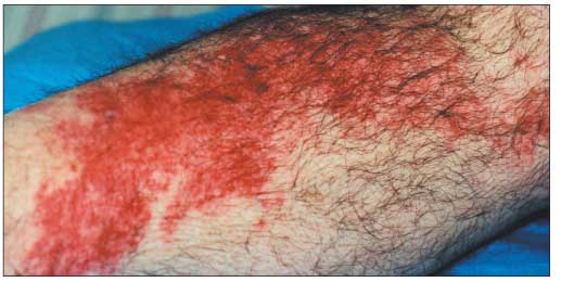 lechenie-rozhistogo-vospaleniya-nogi-v-domashnix-usloviyax