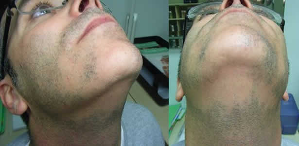 лечение алопеции у мужчин