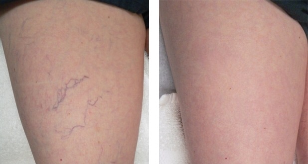 фото до и после лазерной коагуляции