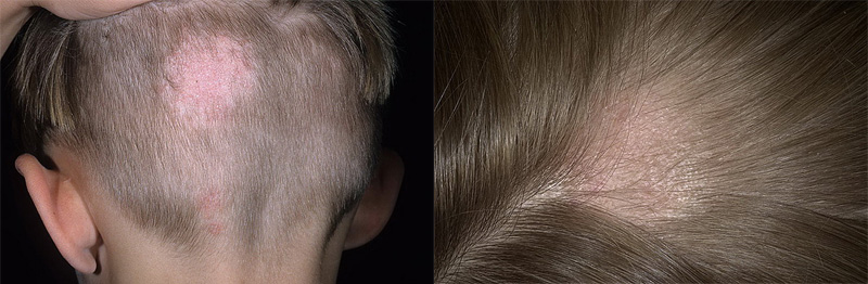 lishaj-na-golove-u-rebenka