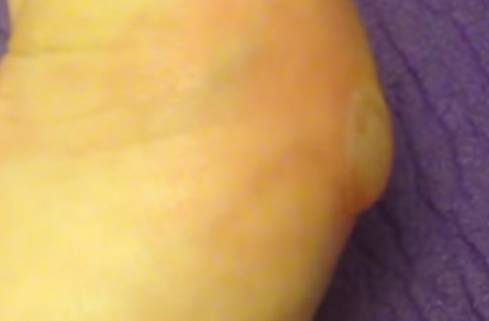 лопнула мозоль