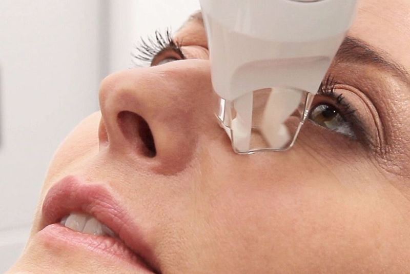 LPG-массаж области глаз