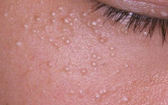 Что делать если появились мелкие прыщики на теле и чешутся?