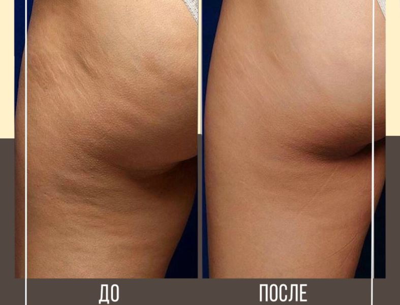 Щетка для сухого массажа: до и после