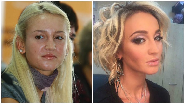 Ольга Бузова до и после пластики