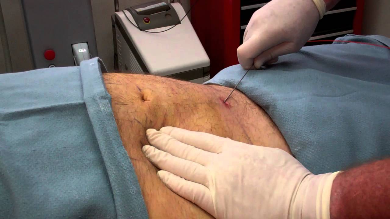 проведение липосакции живота мужчине