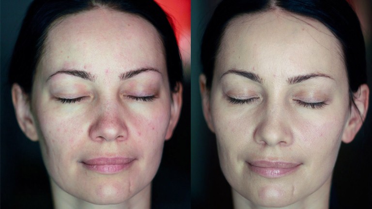 Пилинг коралловый до и после