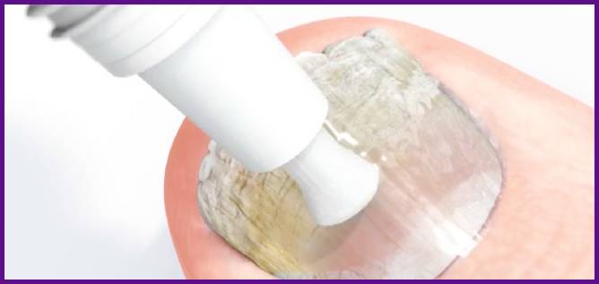 maz ot gribka nogtej