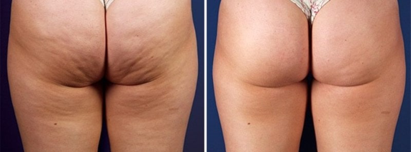 РФ лифтинг ягодиц до и после