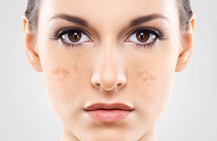 Пигментация на лице