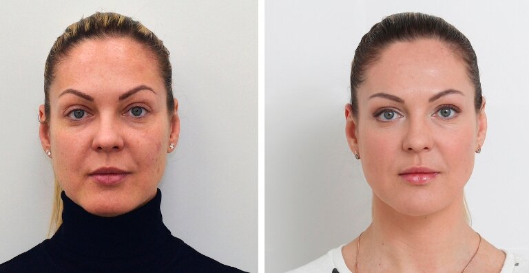 Безинъекционная мезотерапия лица: фото до и после