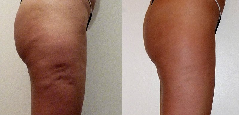 Миостимуляция тела: до и после