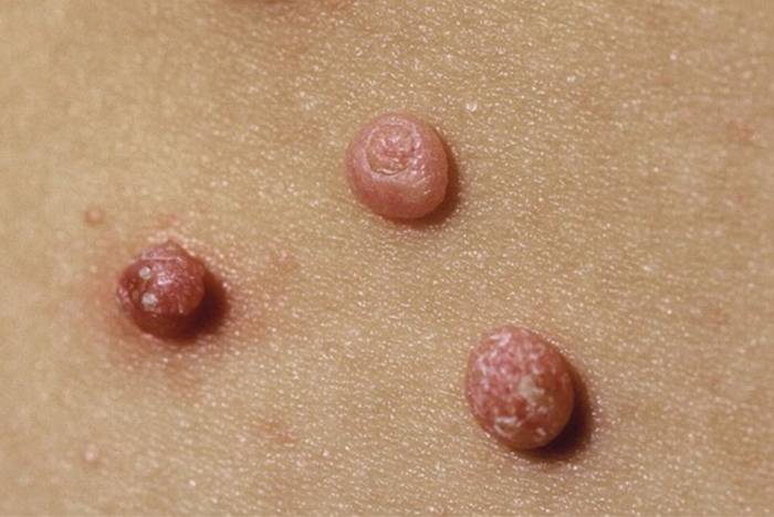 моллюски на лице на фото