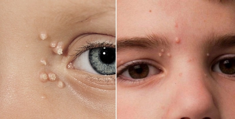 моллюски на лице у ребенка