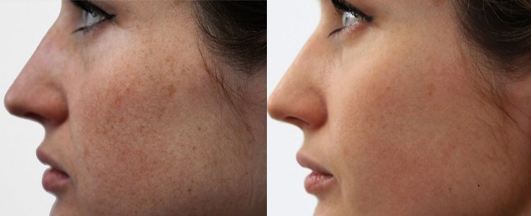 молочный пилинг до и после