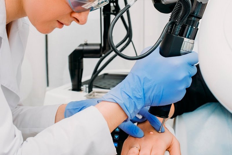 Лазерное удаление мозолей