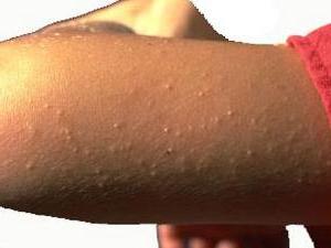 Что делать если появились мелкие прыщики на теле и чешутся?