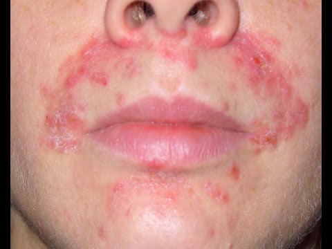 на лице экзема