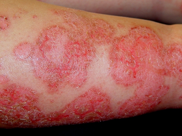 нимулярная экзема фото