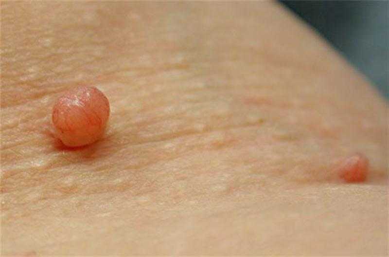 Висячие родинки на коже