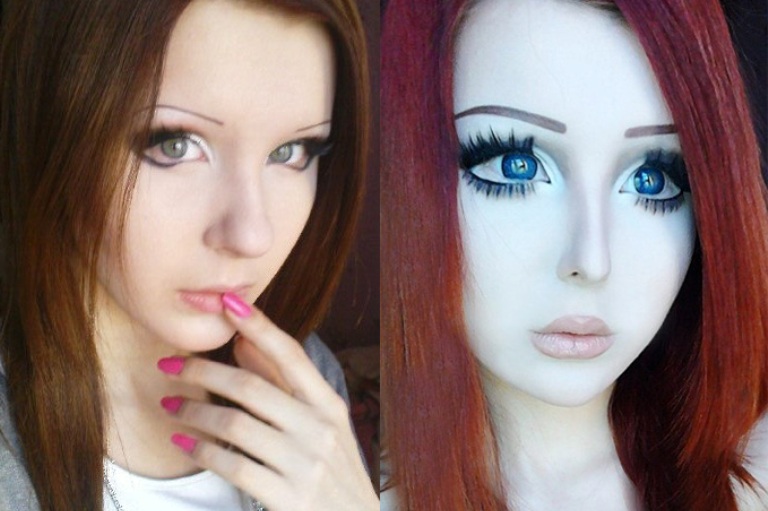 Неудачная ринопластика Шпагиной