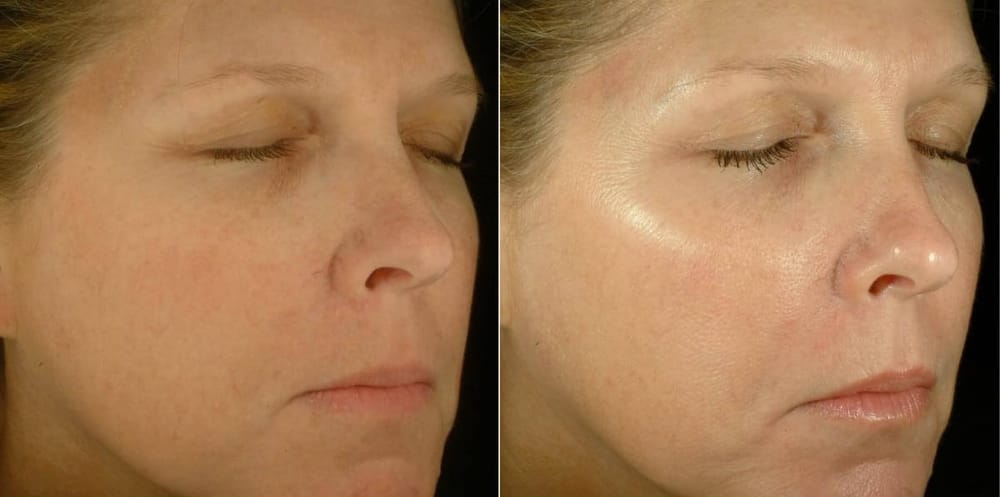 фото до и после электропорации