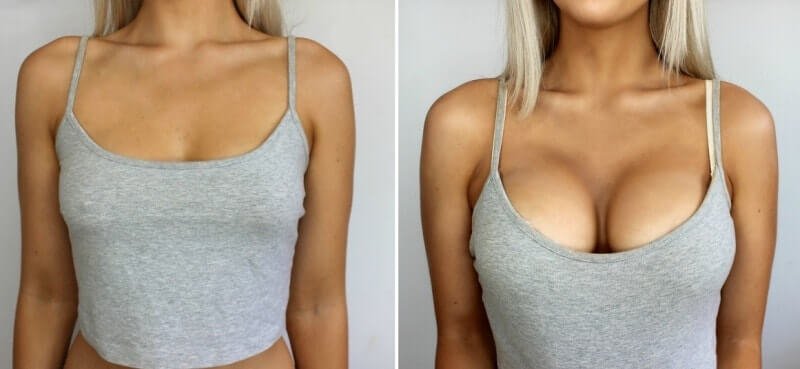 грудь разная до и после
