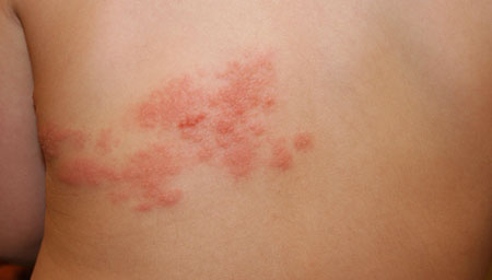 opoyasyvashiy-lishay-foto