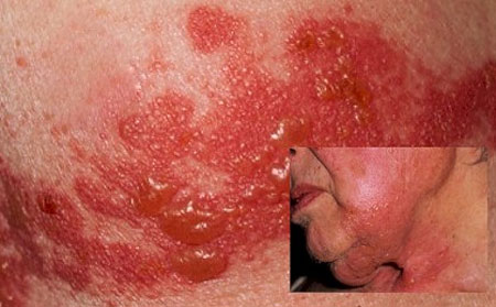 opoyasyvashiy-lishay