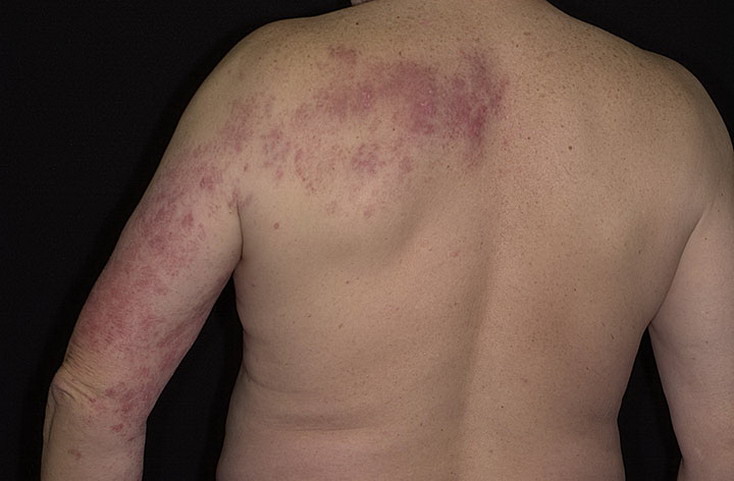 opoyasyvayushhij-gerpes-spine-foto