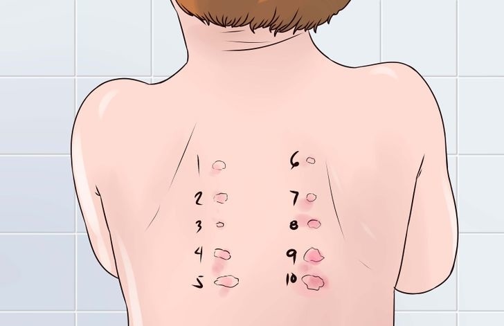 ostraya-krapivnica-u-vzroslyx-i-detej