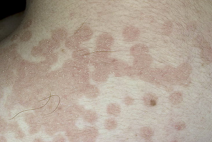 otrubevidnyj-lishaj-chem-lechit