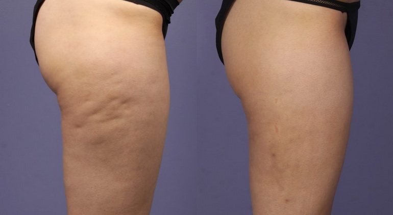 Озонотерапия для похудения: фото до и после