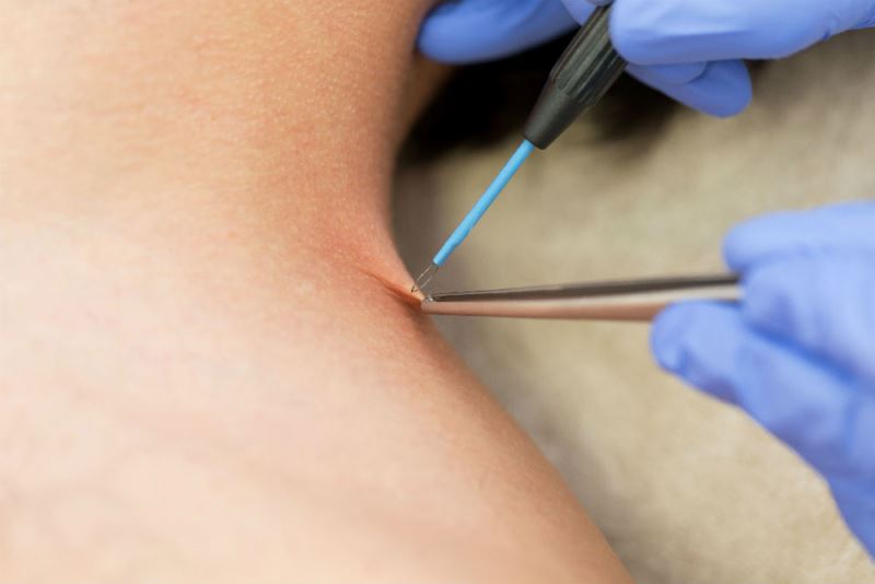 Удаление папиллом в салоне