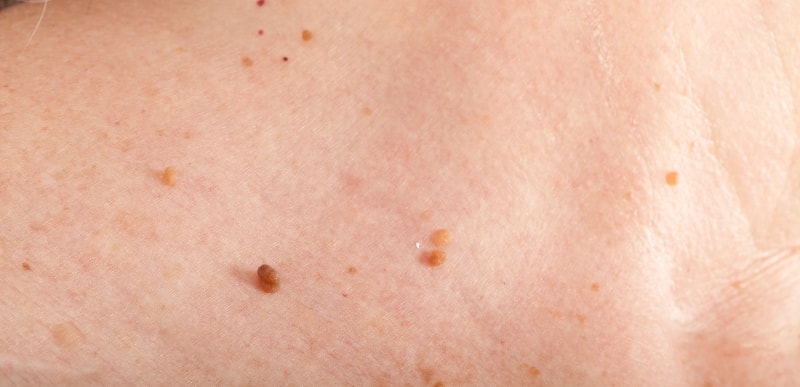 Папилломы на теле