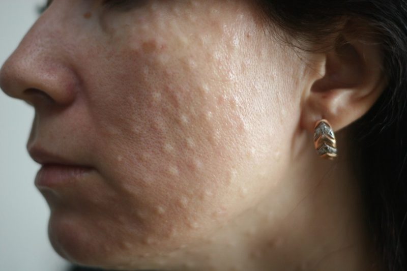 папулы после биоревитализации