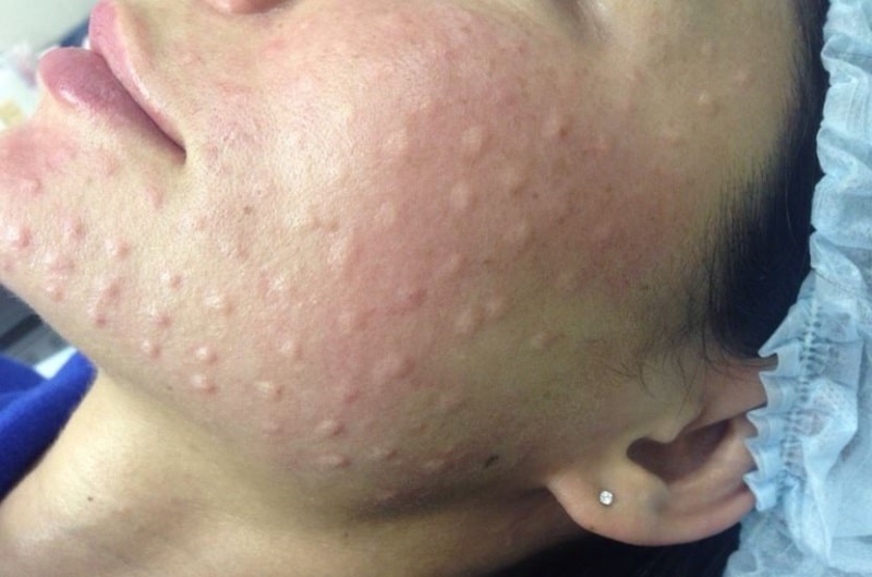Папулы после биоревитализации на лице