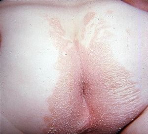 perianalnyj-dermatit-u-rebenka