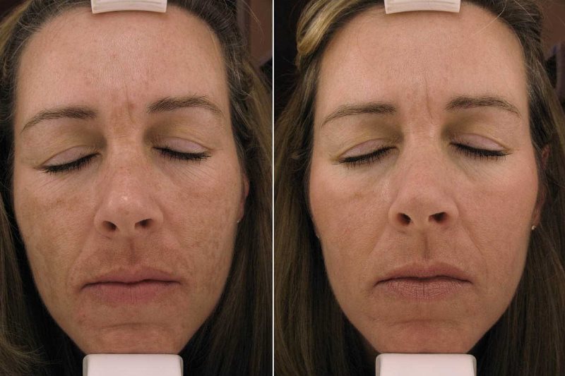 Азелаиновый пилинг: до и после