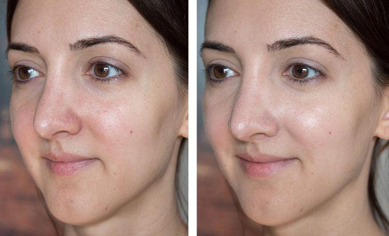 Пилинг салициловый до и после