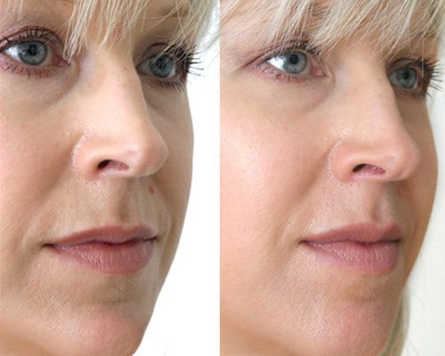 фото до и после химического пилинга