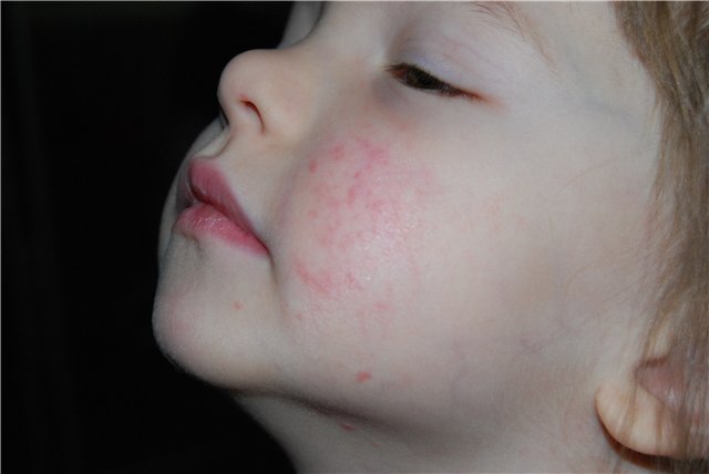 piodermiya-u-detej-simptomy-i-lechenie-foto