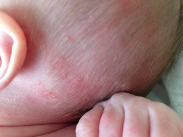 piodermiya-u-detej-simptomy-i-lechenie