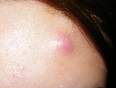 На лице появились подкожные прыщи, что делать и как лечить?