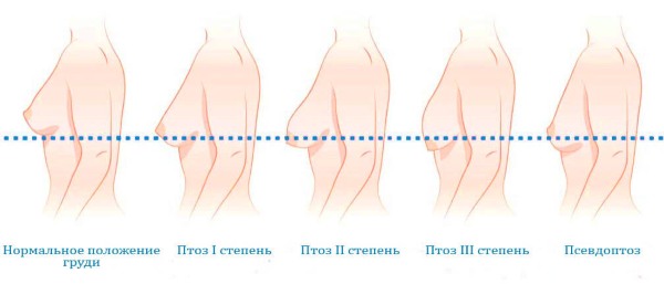 Стадии птоза груди