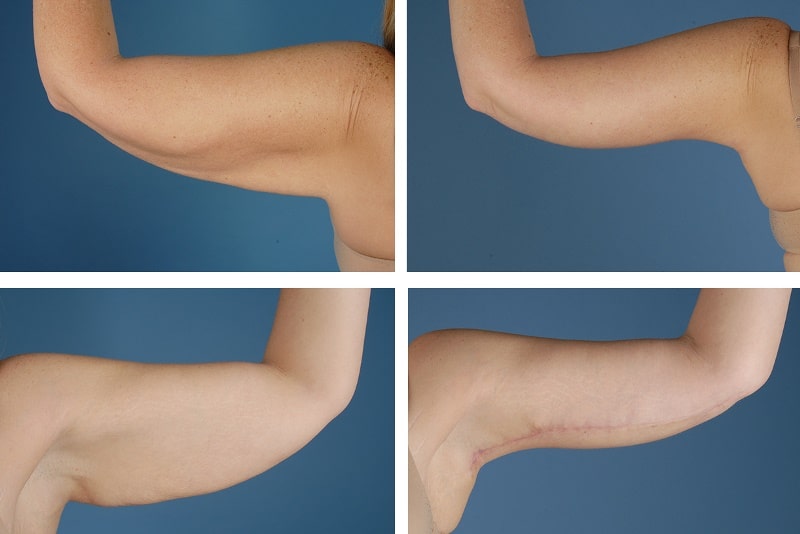 Подтяжка рук до и после