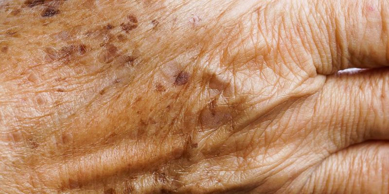 Лентиго: что это такое на фото