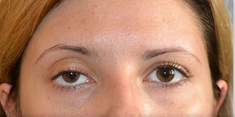 Нависло веко после ботокса вокруг глаз