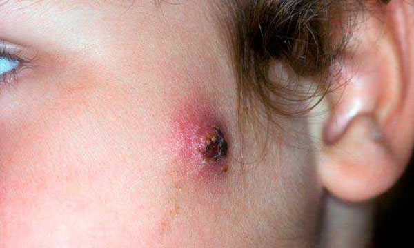 после прищей